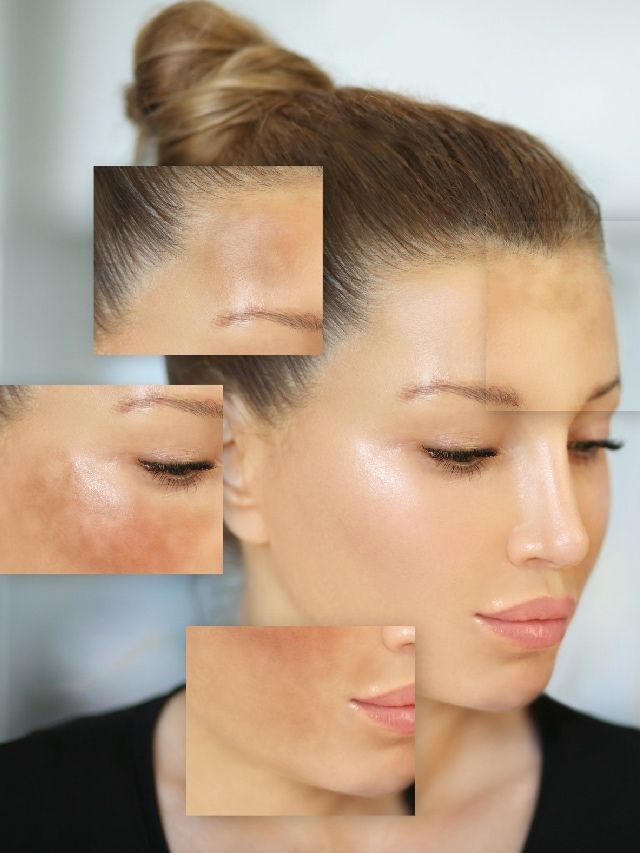 Glow Fast: Say Goodbye to Hyperpigmentation with Kashyapa 1 Hyperpigmentation before and after.